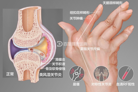 类风湿关节炎（疾病名）