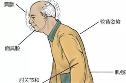姿势性震颤