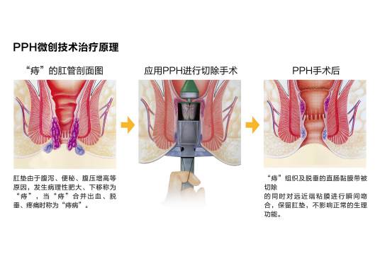 痔疮pph手术