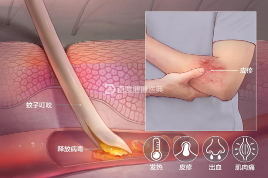 登革热（急性虫媒传染病）