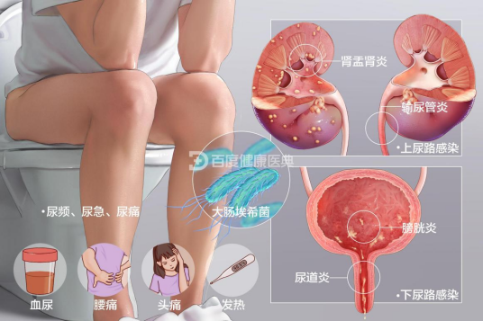 尿路感染
