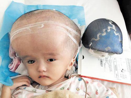 大头娃娃（由于婴儿食用劣质奶粉等而造成的病症）