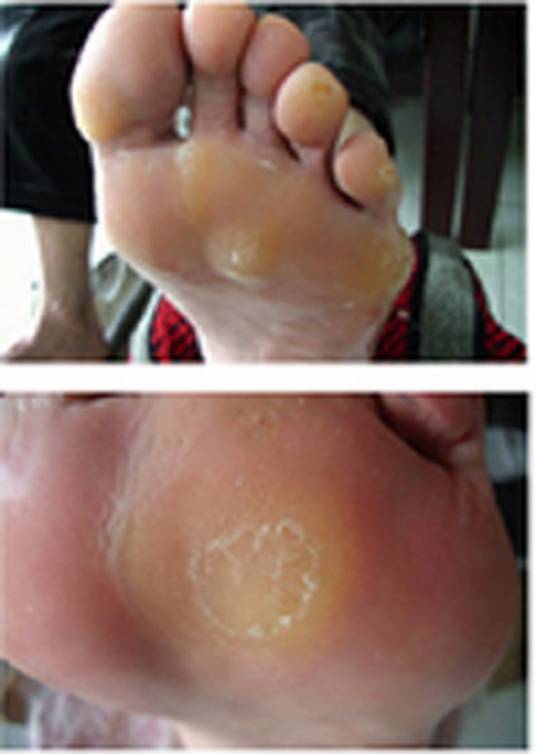 脚垫（足部长的脚垫（患病））