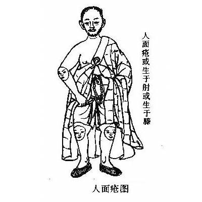 人面疮（一种疾病）