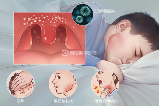 传染性单核细胞增多症