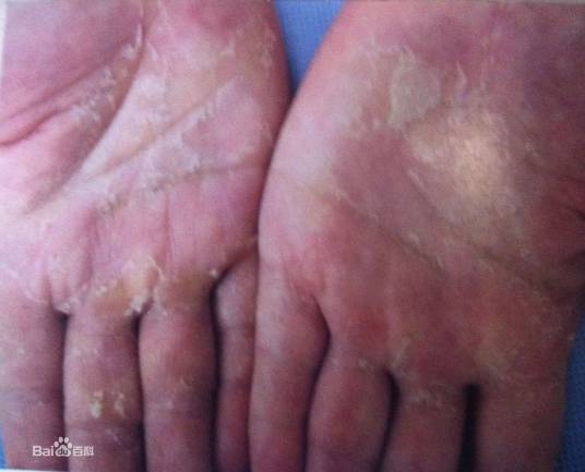 剥脱性角质层松解症