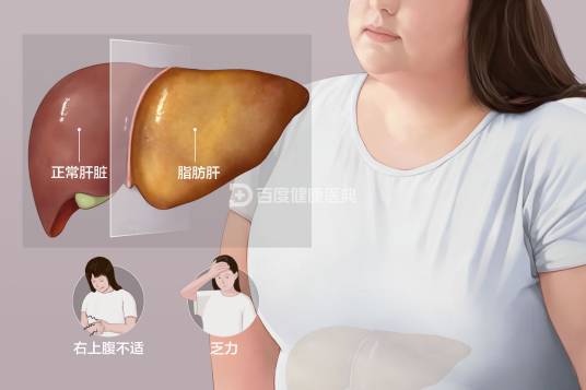 脂肪肝(病症名称)