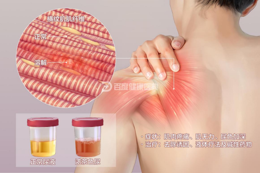 横纹肌溶解综合征