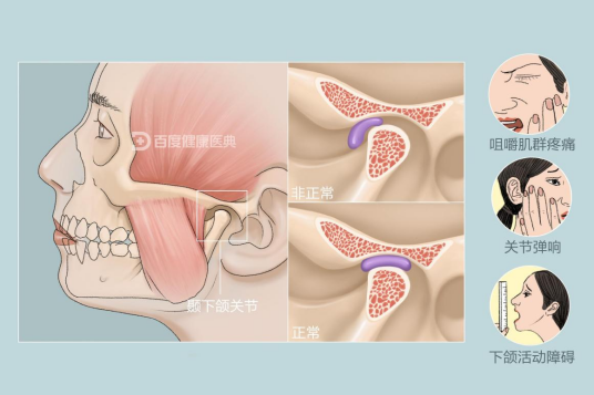 颞下颌关节紊乱综合征