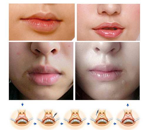 厚唇修薄术