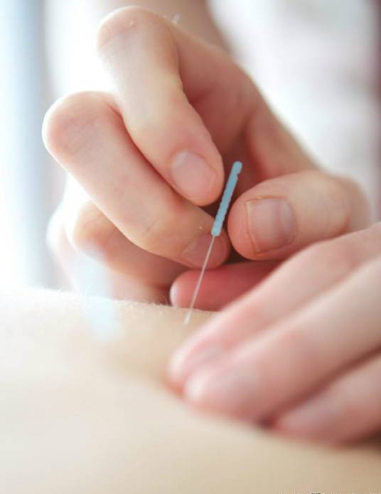 针灸(刺针来治疗疾病)