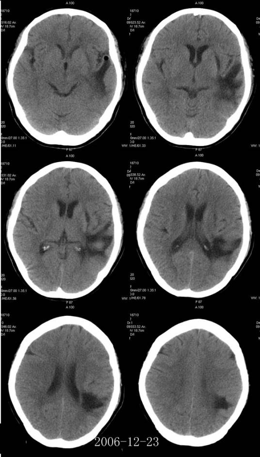 双侧腔隙性脑梗塞